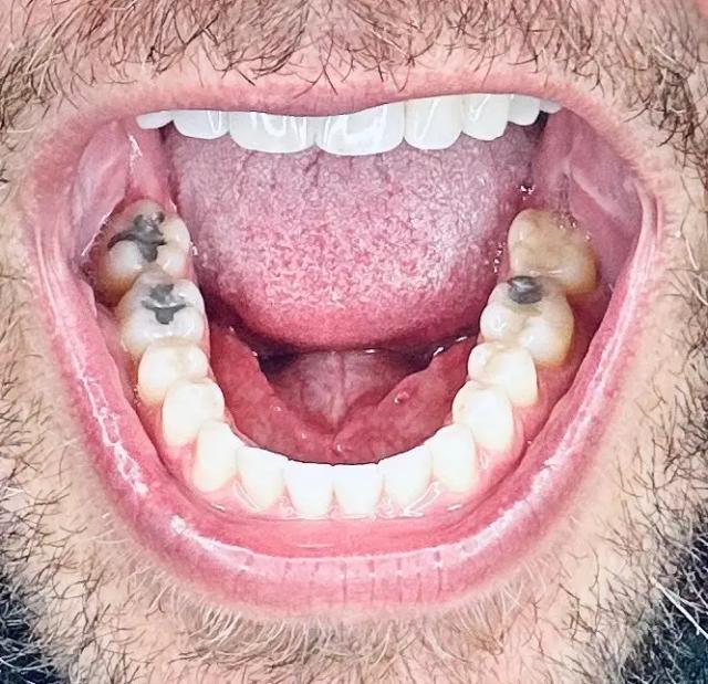 Bigoleteeth14
